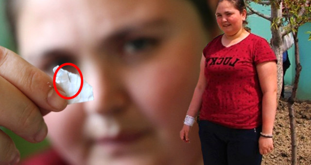 8 Yıl Önce Vücudundan 35 İğne Çıkarılan Genç Kızın Vücudu Yine İğne Üretmeye Başladı