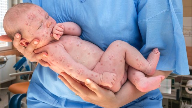 Dünyada Kızamık Salgını Riskini Artıran Aşı Karşıtı 8 Yanlış Bilgi